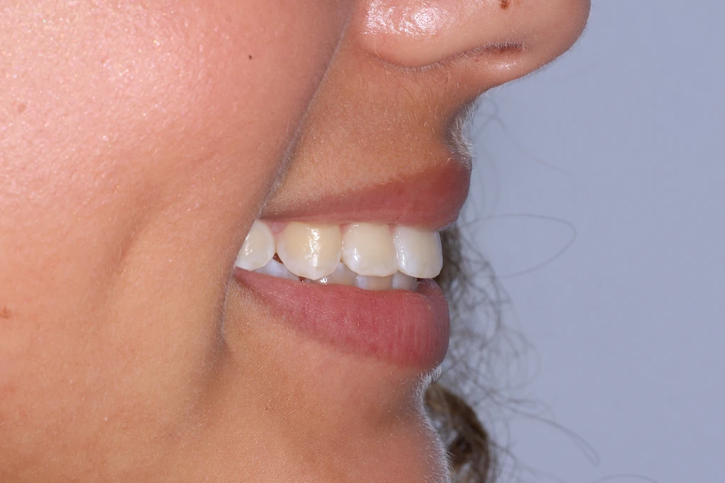 Orthodontist Porter Ranch Results