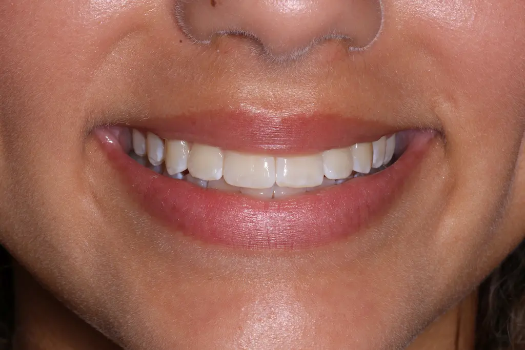 Orthodontist Porter Ranch Results