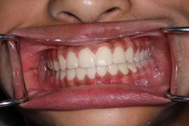 Orthodontist Porter Ranch Results