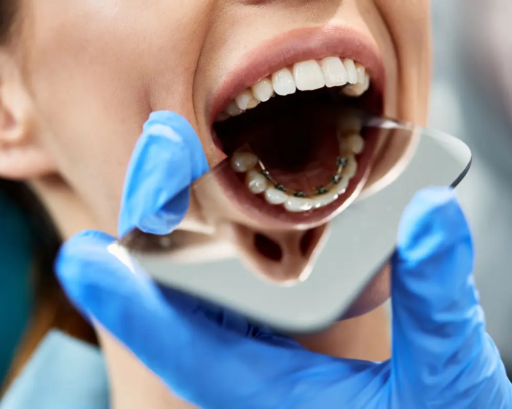 Lingual Braces Porter Ranch