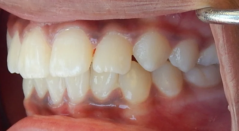 Orthodontist Porter Ranch Results