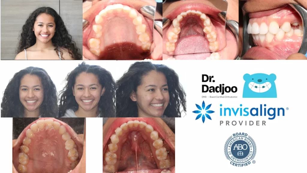 Befor and After braces Porter Ranch Orthodontist