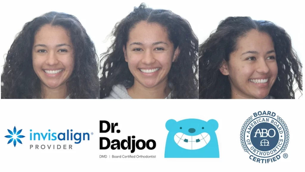 Befor and After braces Porter Ranch Orthodontist