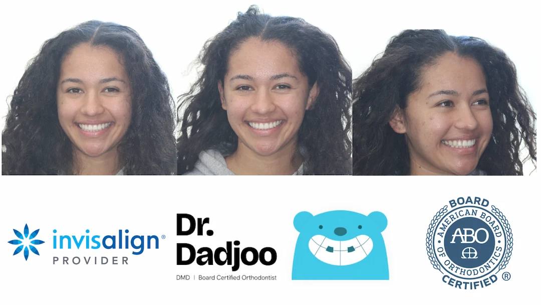 Befor and After braces Porter Ranch Orthodontist