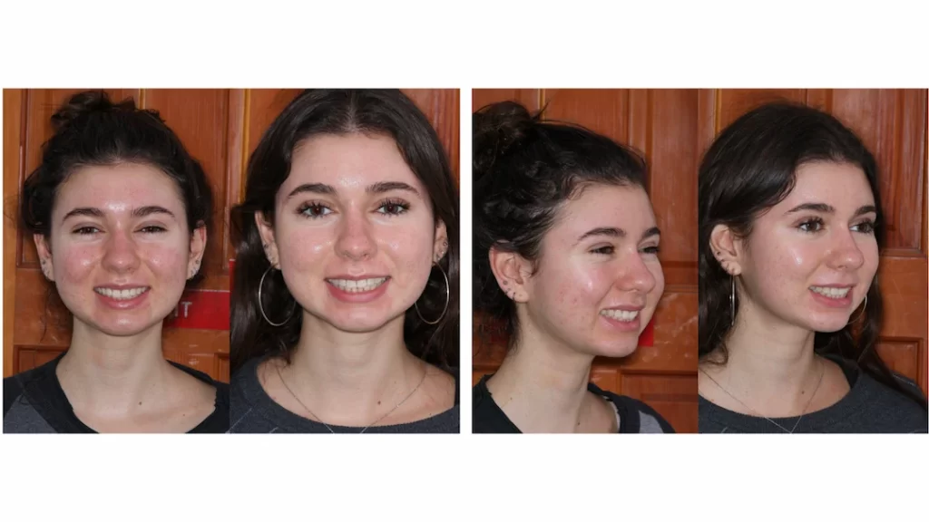 Befor and After braces Porter Ranch Orthodontist