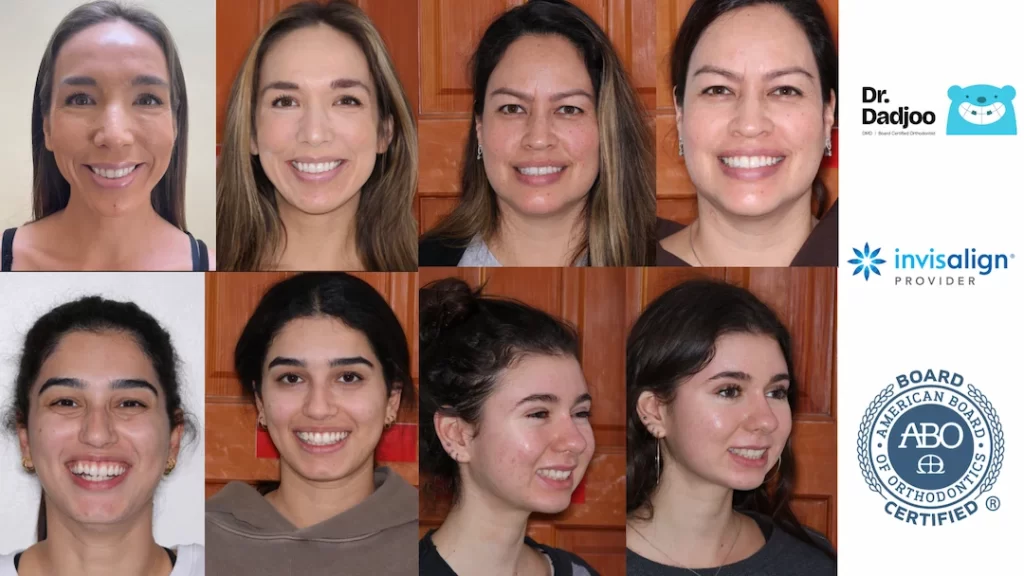 Befor and After braces Porter Ranch Orthodontist