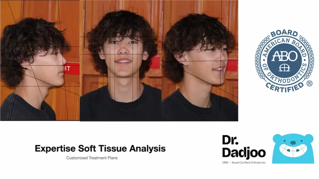 Befor and After braces Porter Ranch Orthodontist