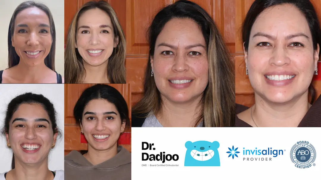 Befor and After braces Porter Ranch Orthodontist