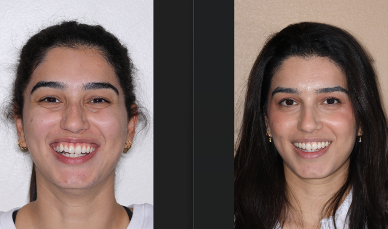 Beautiful smile made at Dadjoo Orthodontics