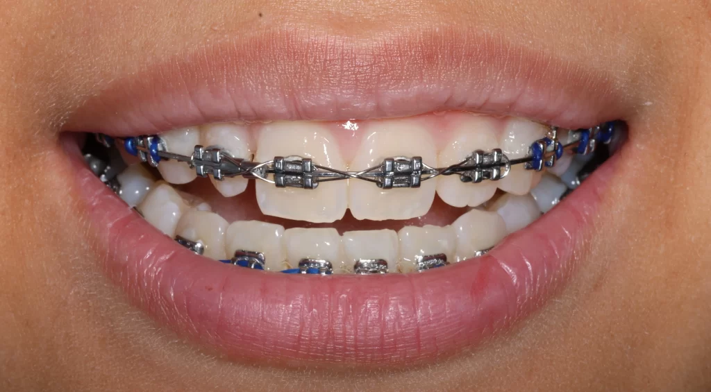 Twin traditional metal braces
