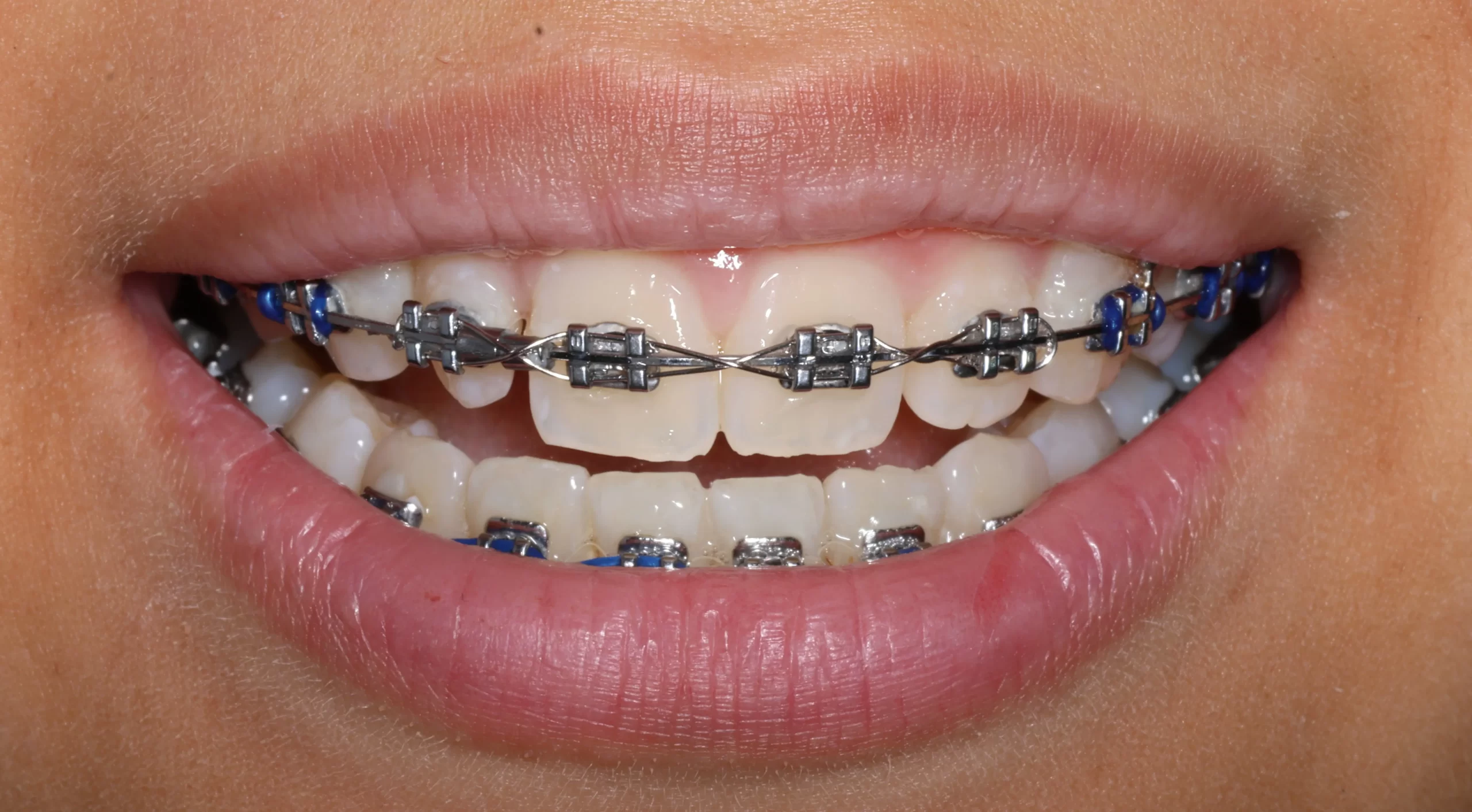 Twin traditional metal braces
