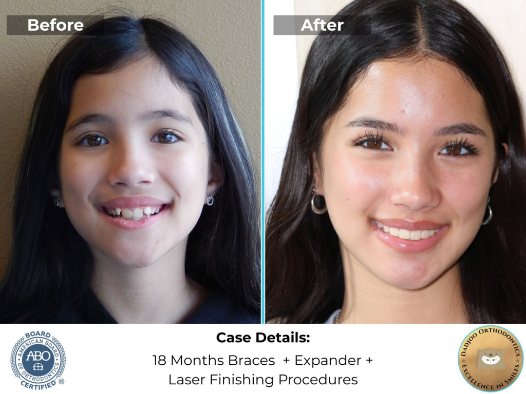 Braces and Expanders for Airway - Dr. Dadjoo Orthodontist in Porter Ranch and the Valley
