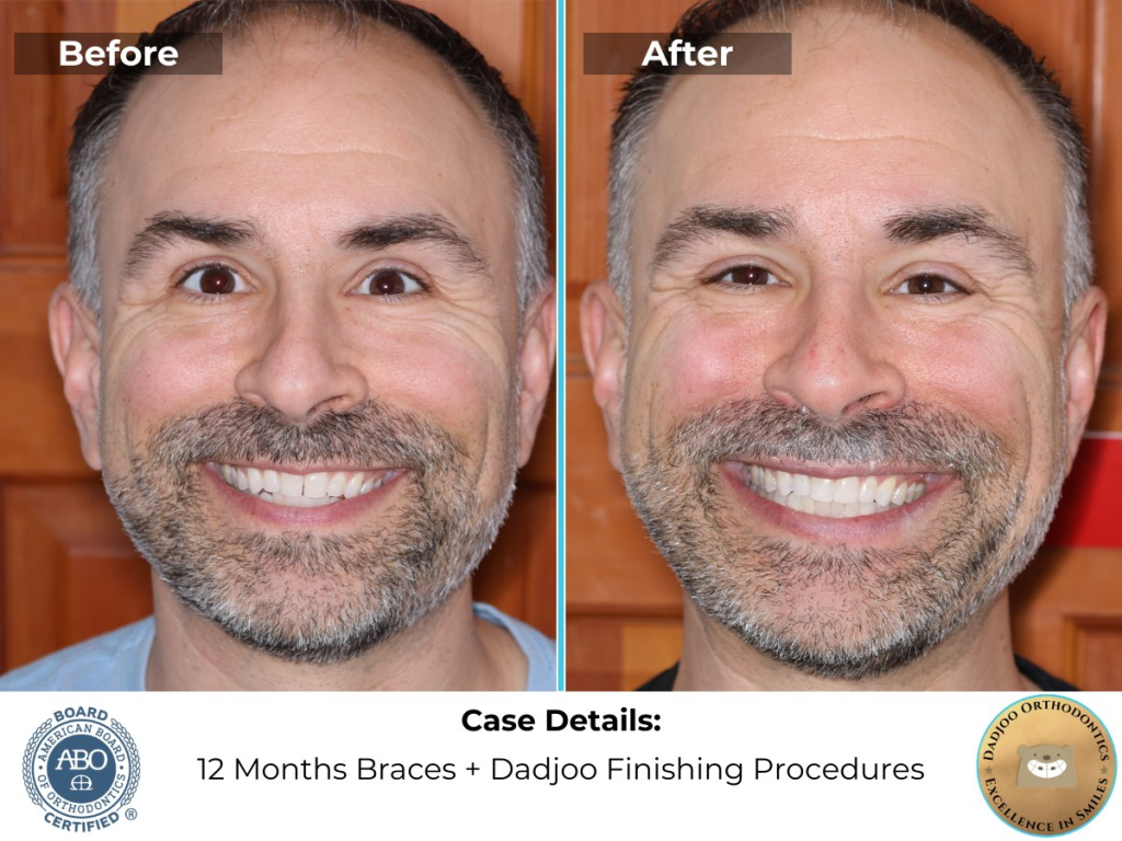 Invisalign for Adults crowding - Dr. Dadjoo Orthodontist in Porter Ranch