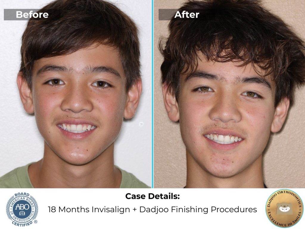 Teen Invisalign Before and After with Dr. Dadjoo for crowding and overbite