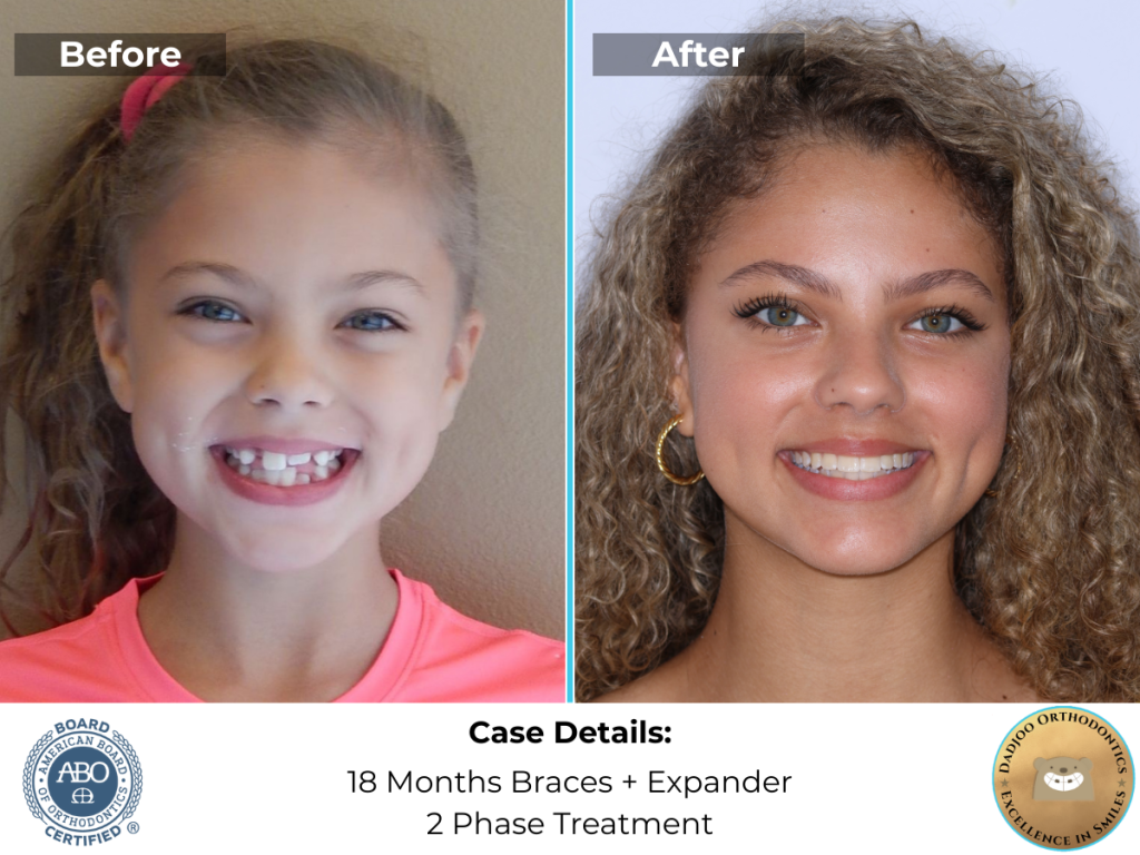 Child Orthodontics - Phase I and Phase II with expander and Braces - Dadjoo Orthodontics In Porter Ranch, CA