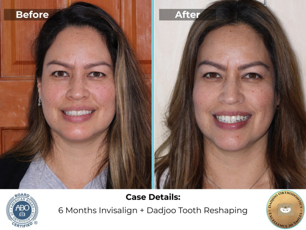 Porter Ranch Orthodontist - Before and After - Adult Invisalign using invisible braces