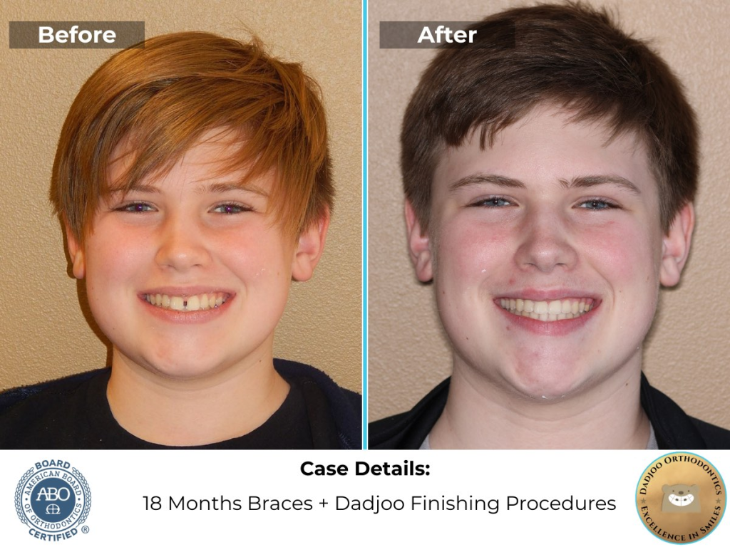 Teen Braces for Families in the Valley - Dr. Dadjoo Porter Ranch shows before and after space closure