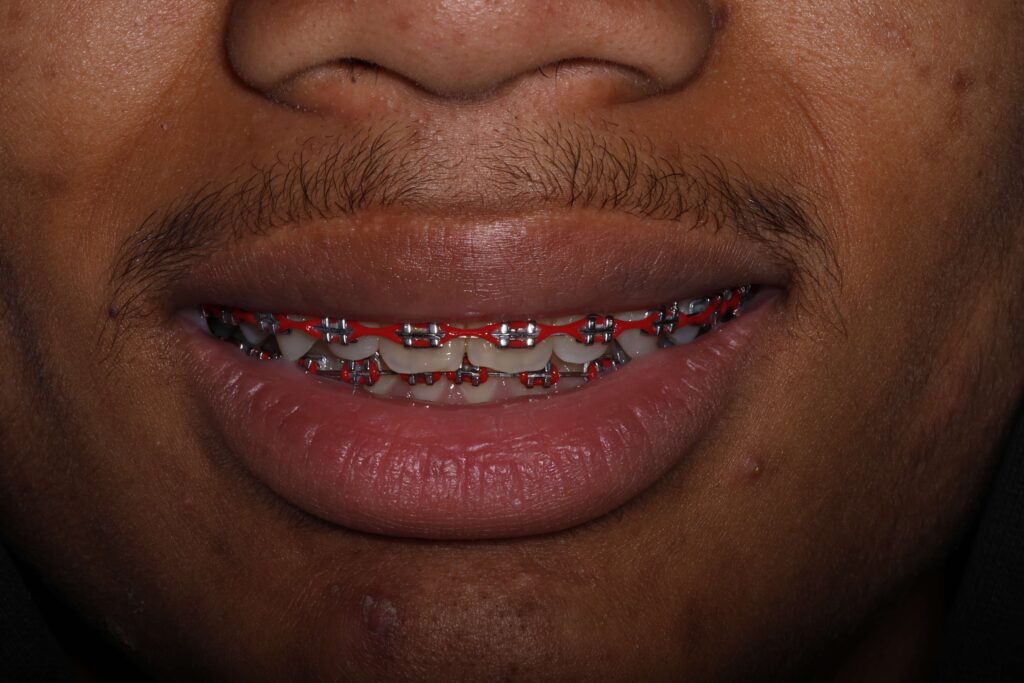 Northridge, California Red Braces - CSUN Braces