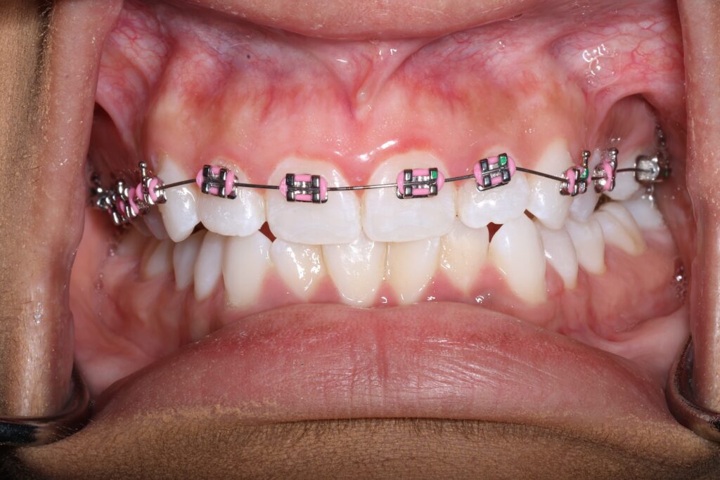 Northridge Braces Northridge Orthodontist Dr. Dadjoo