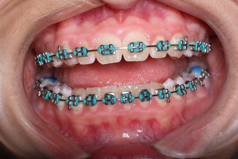 Best Braces Colors in 2025: How to Choose the Perfect Shade for Your Smile