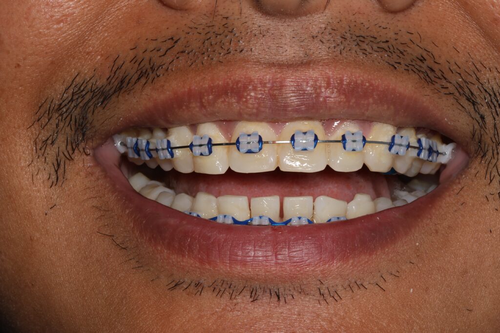 Adult Braces Treatment