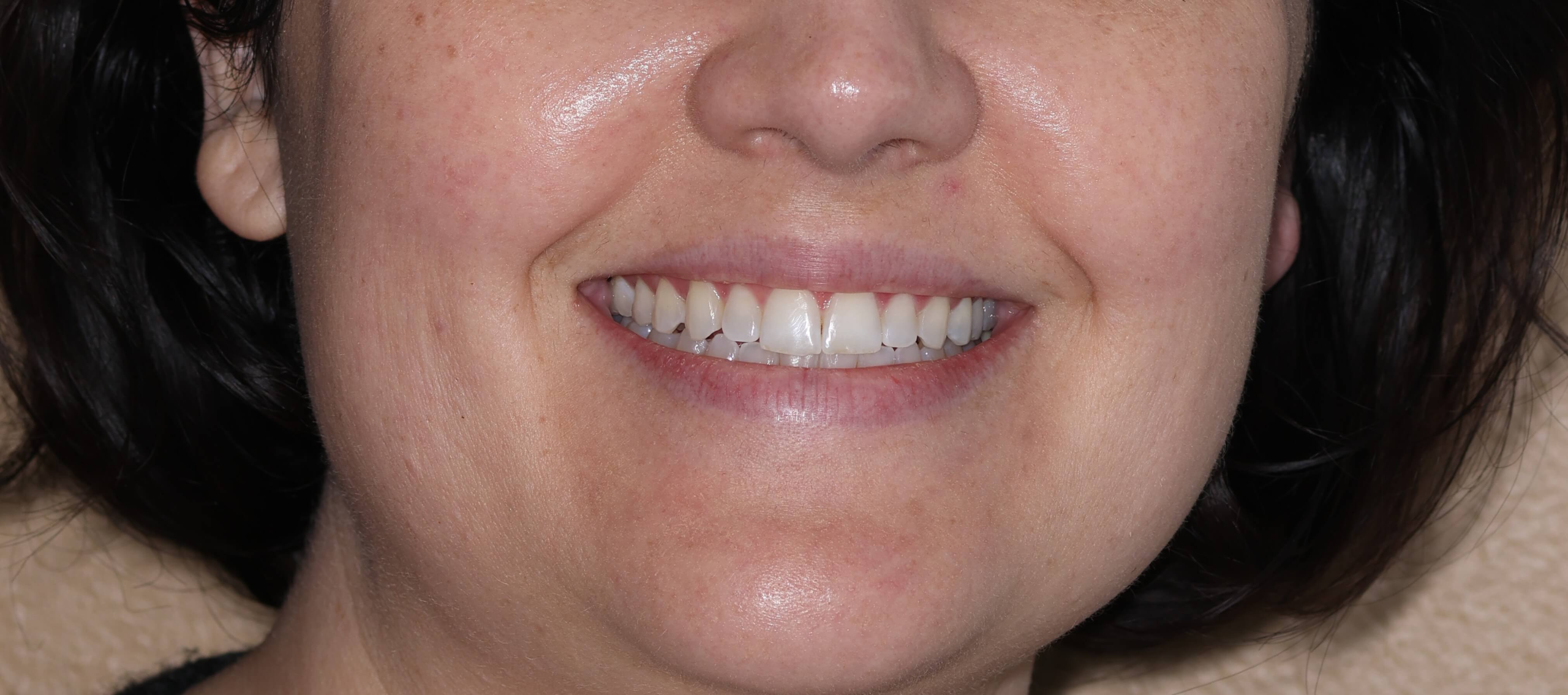 Invisalign in Porter Ranch: A Clear Path to a Beautiful Smile