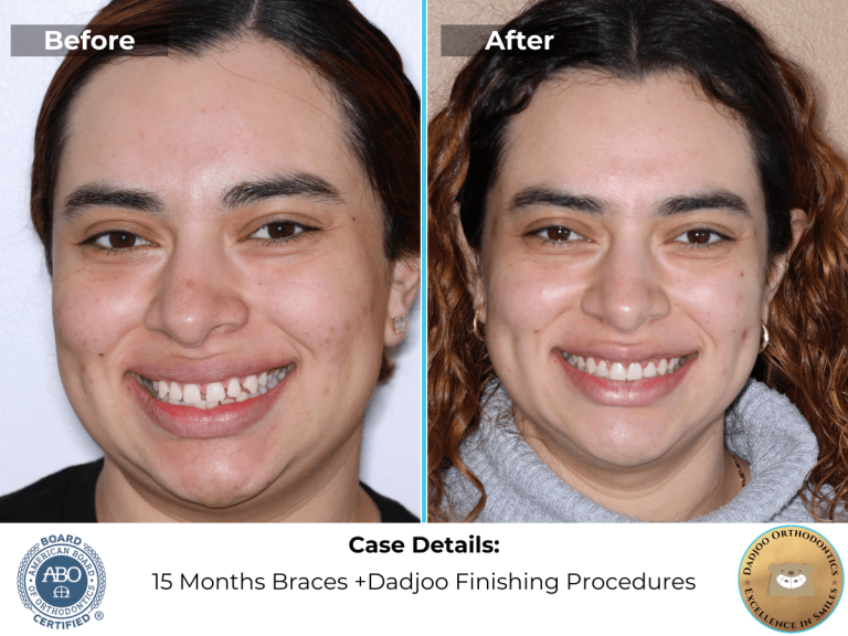 Why do People Get Braces?