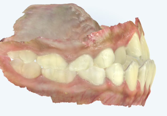 Northridge Orthodontist for Invisalign