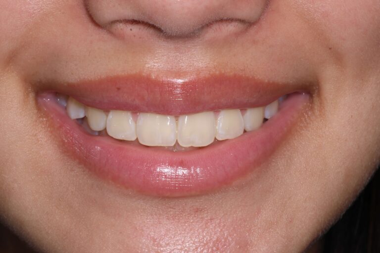 Your Smile Is Too Important to Trust to Chance — Why an Orthodontist Is the Only Right Choice for Invisalign