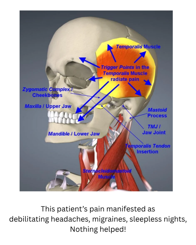 Six Years of Pain, Six Months to Relief: How Orthodontics Resolved Chronic TMD