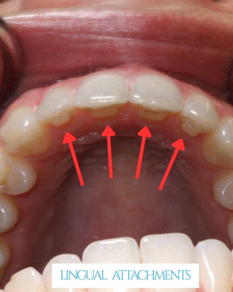 Occlusal intraoral photograph labeled "Lingual Attachments," showing a top-down view of the maxillary arch. Four red upward-pointing arrows indicate tooth-colored resin extrusion attachments bonded to the lingual (palatal) surfaces of the upper anterior teeth, used to facilitate vertical tooth movement during clear aligner treatment without visible buccal attachments.
