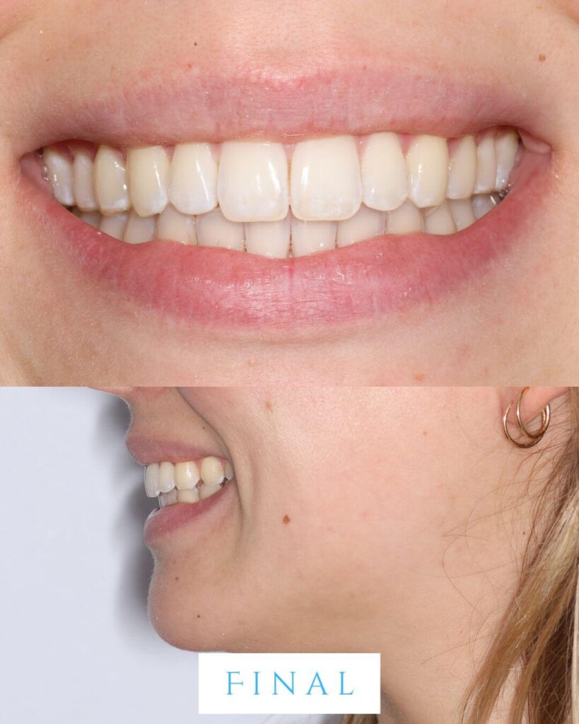 Two-panel photograph labeled "Final." Top panel shows a frontal smile with upper and lower front teeth in full contact, resolved open bite, and normalized overjet following clear aligner orthodontic treatment. Bottom panel shows a relaxed profile view of the patient smiling naturally, demonstrating improved lip posture and anterior tooth contact with no visible orthodontic attachments.