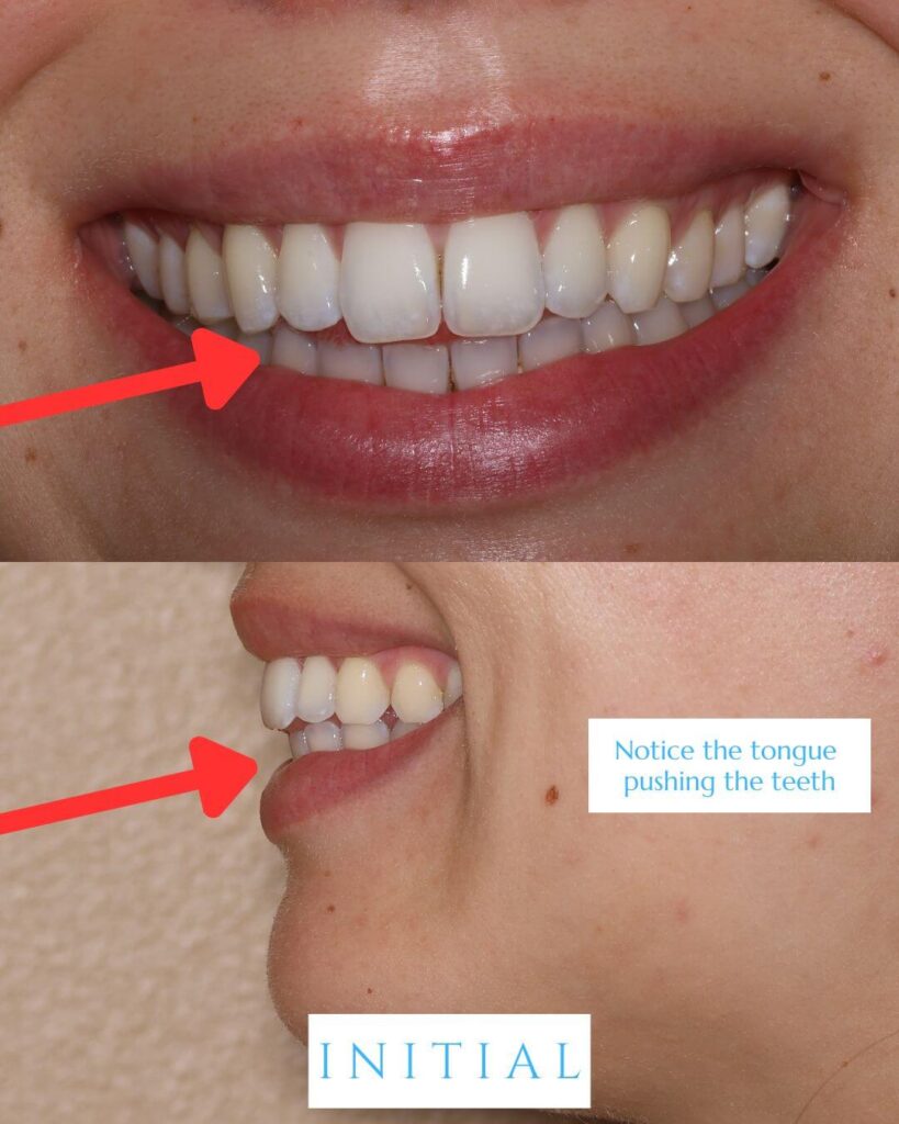 Two-panel intraoral photograph labeled "Initial." Top panel shows a frontal view of an anterior open bite with a visible gap between the upper and lower front teeth and increased overjet, with a red arrow pointing to the open contact. Bottom panel shows a profile view with the tongue visibly protruding between the upper and lower incisors, annotated with the note "Notice the tongue pushing the teeth."